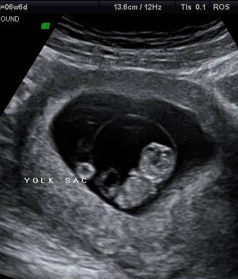 5 weeks pregnant dating scan